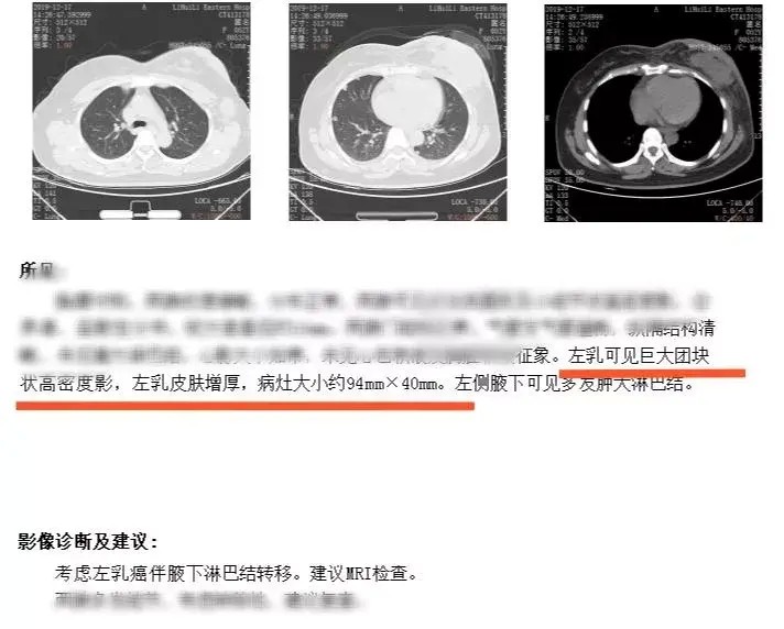 身体发现肿块她选择用按摩消除结果一年后崩溃了